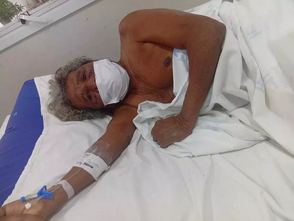 “Irreconhecível e em choque”, diz família de idoso desfigurado por pitbull