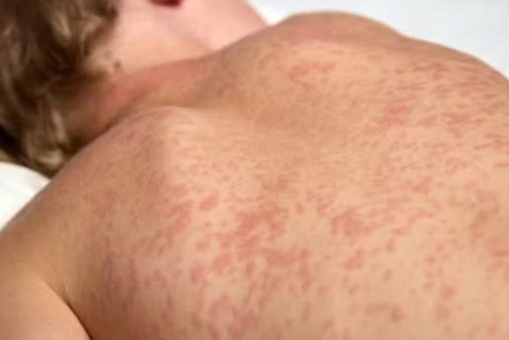 Bebê de 8 meses é investigado como caso suspeito de sarampo em MS