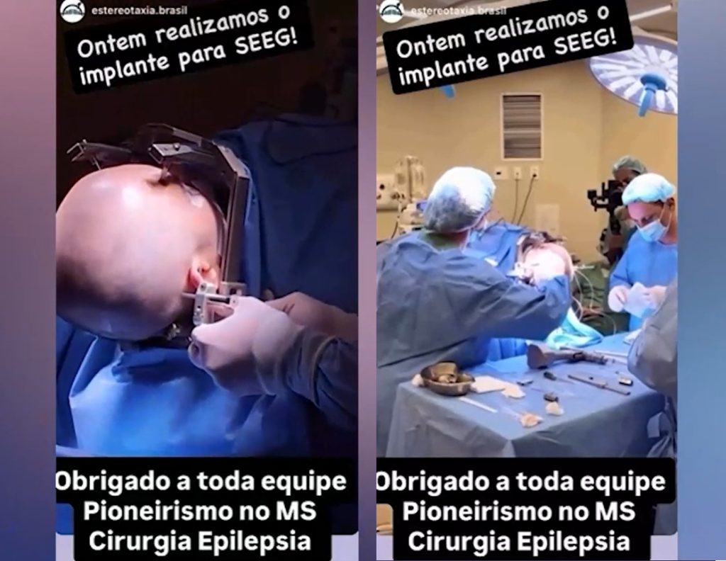 No Proncor, procedimento raro mapeia foco da epilepsia