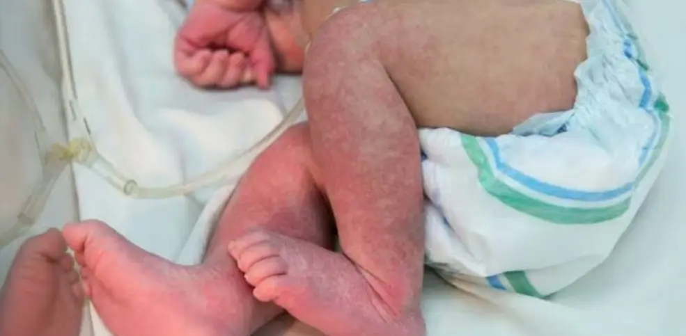 SES-MS confirma morte de bebê de um mês por chikungunya e óbitos sobem para seis